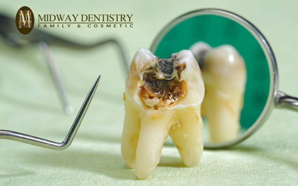 Cavities Prevention