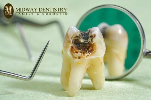 Cavities Prevention
