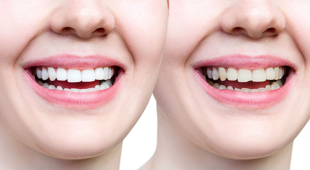 Chipped Tooth? Learn about procedures and options - Midway Family and  Cosmetic Dentistry