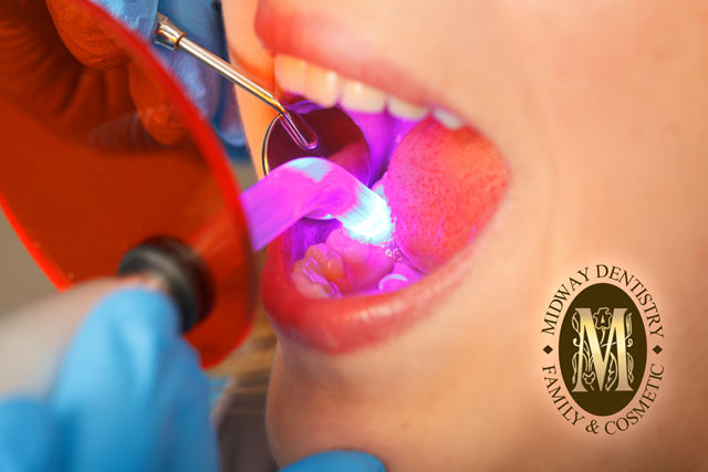 Dental Fillings using UV