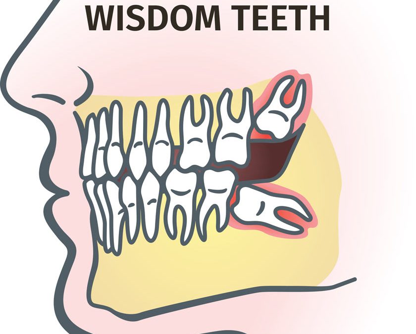 Wisdom Teeth