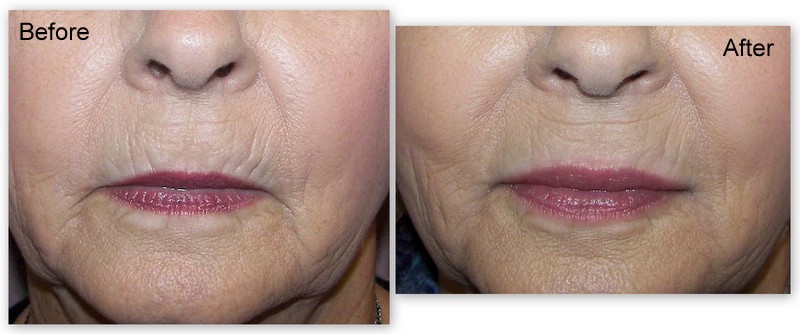 Botox Juvederm before and after